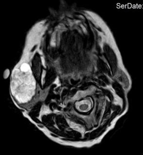 MRT des Halses der Patientin in T2-Wichtung Querschnitt