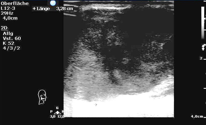 Sonographie des intraparotideal gelegenen Tumors 