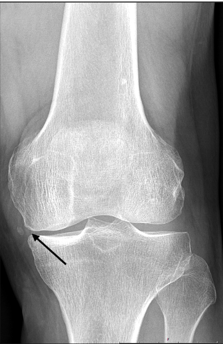 Linkes Knie eines 57-jährigen Patienten in konventionelle Radiografie