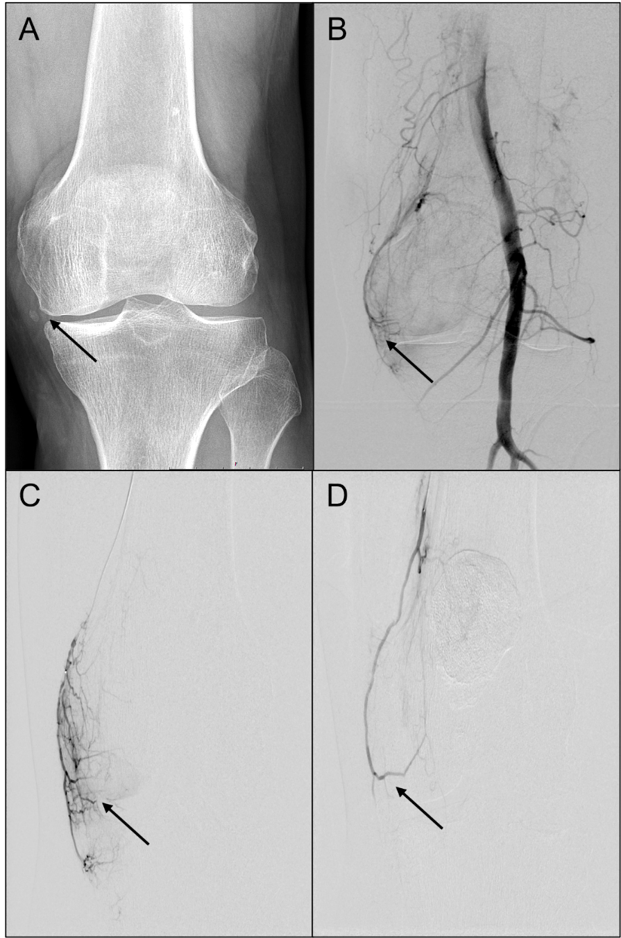 Linkes Knie eines 57-jährigen Patienten vor, während und nach transarterieller Embolisation (TAPE).