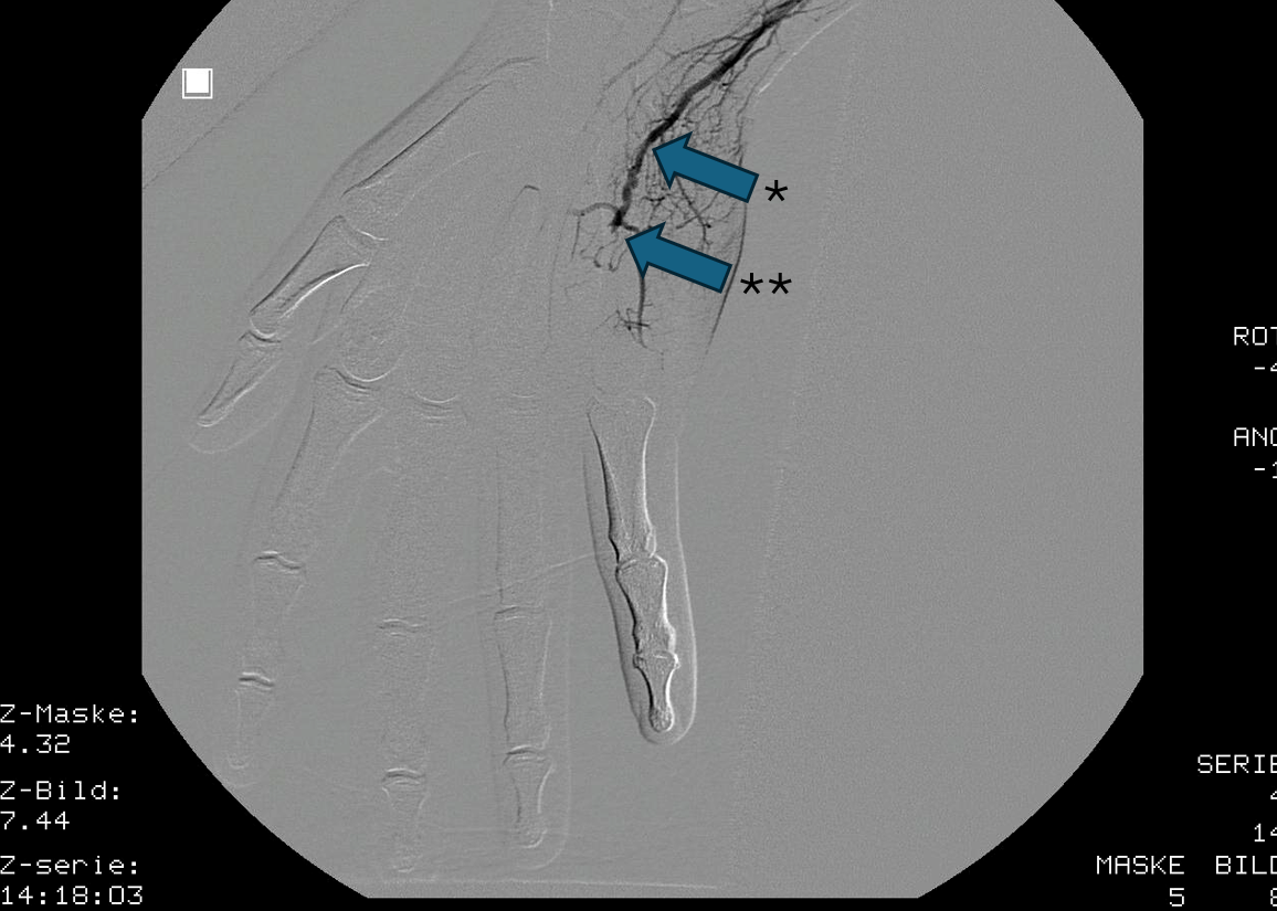 Angiographie Angiographie