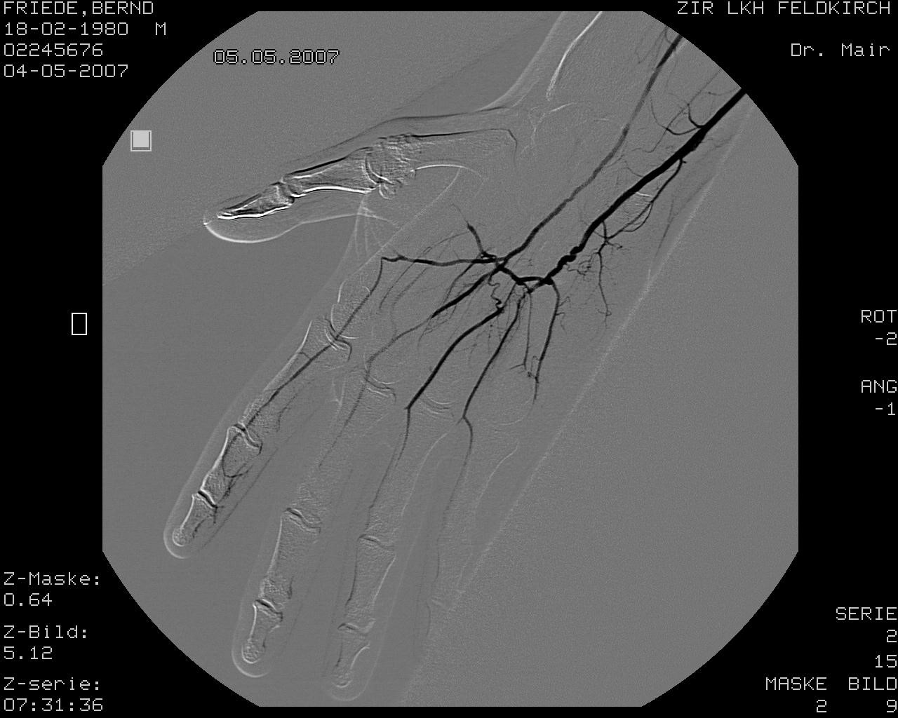 Angiographie