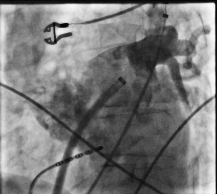 Pulmonalvenen-Angiografie aller vier Pulmonalvenen