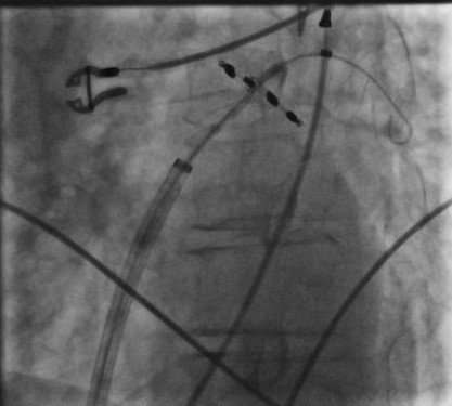 Positionierung des PFA Katheters im Ostium der linken oberen Pulmonalvene