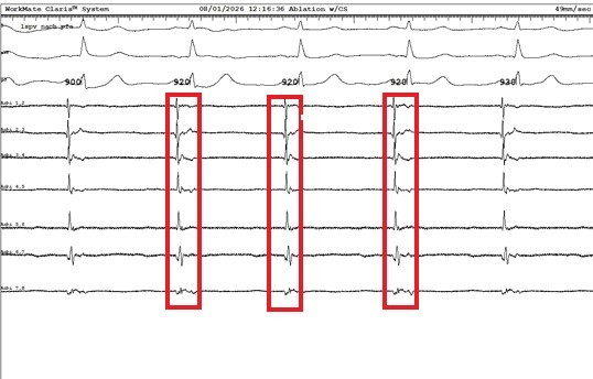 Pulmonalvenensignal nach Impulsabgabe