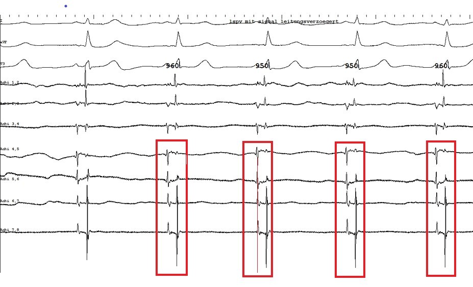 Pulmonalvenensignal nach Impulsabgabe